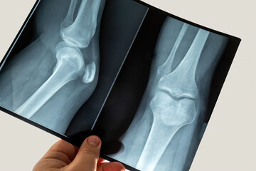doctor looking at x-ray film of knee joint. picture hold in hand. diagnosis arthritis, patellar,...