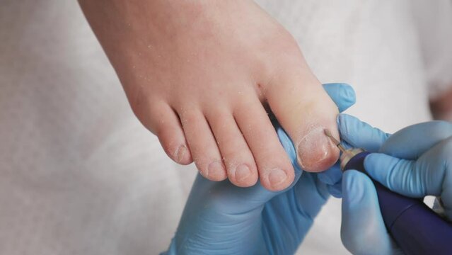 Podiatrist in blue gloves polishes the toe cuticle toe fingers with a mechanical device with a abrasive nozzle. Close-up, top view. The concept of a podiatry, podology and chiropody.