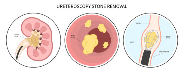 Fototapeta premium Kidney Painful treatment stone removal uric acid Blocked ureter Shockwave uropathy cyst pelvis urinating bleeding catheter urologist ureteric tumor Blood in urine biopsy