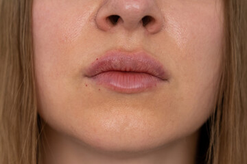 visible place of needle injection marks, woman lips push up close up view after lip augmentation procedure with fillers, increase lips hyaluronic acid, swelling after cosmetic procedure, cosmetician