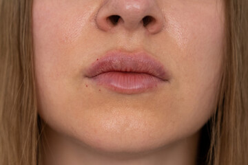 Obraz premium visible place of needle injection marks, woman lips push up close up view after lip augmentation procedure with fillers, increase lips hyaluronic acid, swelling after cosmetic procedure, cosmetician