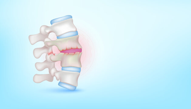 Backbone Disc Joint Degeneration Herniation Cartilage On Blue Background With Copy Space For Text. ฺBone Human Skeleton Anatomy Of The Body. Medical Health Care Science Concept. Realistic 3D Vector.