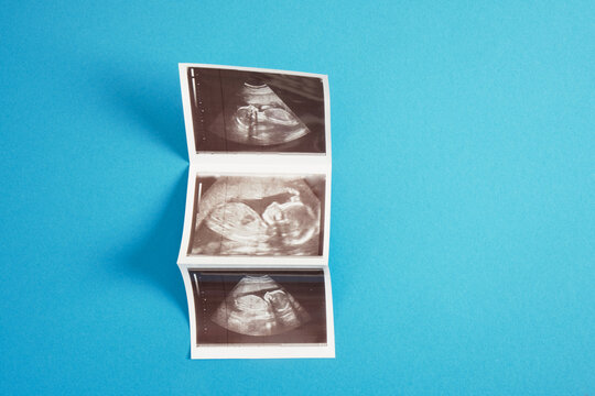 Ultrasound picture pregnant baby photo on blue background