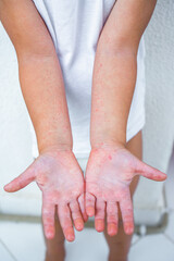 Enterovirus Leg - arm - mouth. Rash on the body of a child. Cocksackie virus.