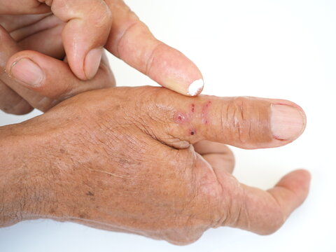 Elderly man is applying a finger cream to the area of ​​insect bites. Closeup photo, blurred.