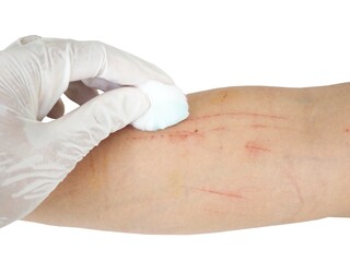 A doctor cleans a patient's arm that the cat has scratched. Closeup photo, blurred.