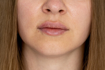 woman lips push up close up view after lip augmentation procedure with fillers, increase lips hyaluronic acid, visible place of needle injection marks, swelling after cosmetic procedure, cosmetician