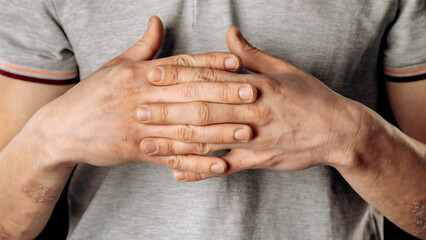 Fototapeta premium Close-up of men's hands with dry skin damage. The concept of dermatology is human hands with skin with cracks and wounds.