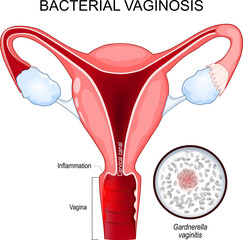 Bacterial vaginosis - obrazy, fototapety, plakaty