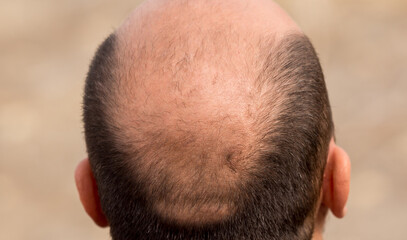 Fototapeta premium Bald head nape head baldness, hair transplant hair loss, stress