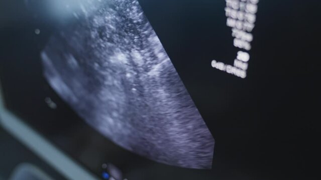 Screen of Modern Ultrasound Machine at Hospital While Young Boys Healthcheck