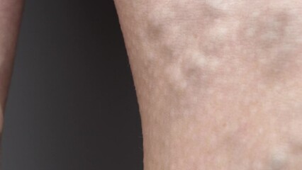 leg with varicose vein closeup. High quality FullHD footage