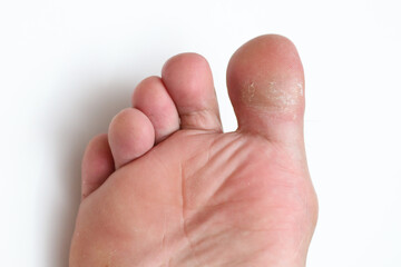 Dry skin crack on big toe with isolated white background, xeroderma
