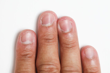 Dry skin crack on all fingernail with isolated background, xeroderma