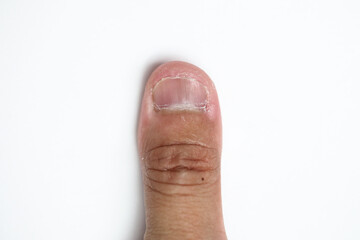 Dry skin crack on thumb fingernail with isolated white background, xeroderma