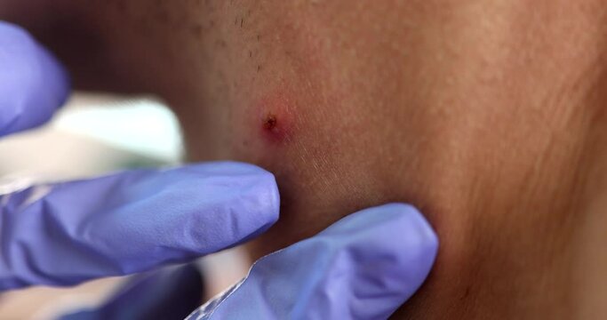 Doctor wearing rubber gloves examining furuncle on patient neck closeup 4k movie slow motion