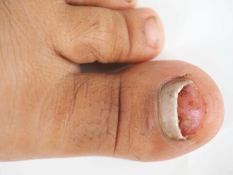 Toenail infection in human. Closeup photo, blurred.