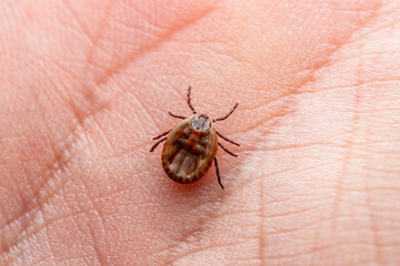 Infectious Encephalitis Tick Insect on Skin. Encephalitis Virus or Lyme Borreliosis Disease Infected Dermacentor Tick Arachnid Parasite Bite Close-up.