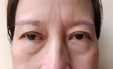 Fototapeta premium Bags under the eyes of a woman have swelling.