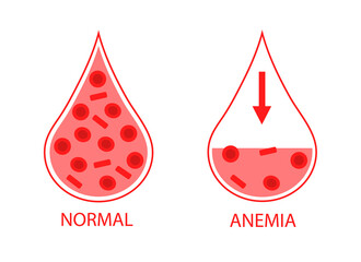 Comparing two drops of blood normal and anemic blood cells. Low hemoglobin. Isolated image on white background. - obrazy, fototapety, plakaty