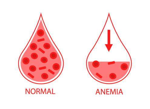 Comparing Two Drops Of Blood Normal And Anemic Blood Cells. Low Hemoglobin. Isolated Image On White Background.