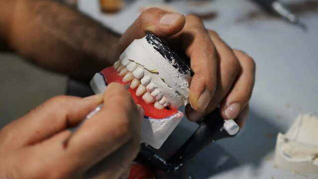 The hands of a dentist dental technician using a sharp scalpel make the final trimming of a removable denture by cutting off the wax between the teeth, holding the prosthesis of the lower jaw