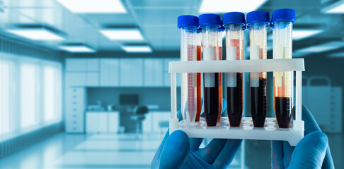 Genetic analysis. Hands of geneticist with test tubes. Blood to study patients DNA. Analysis of RNA...