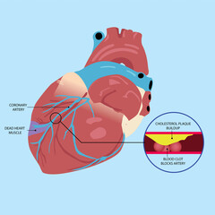 Illustration of Artery with cholesterol buildup, Cholesterol plaque buildup, blood clot blocked,