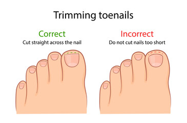 correct and improper cutting of the toenail. medical illustration