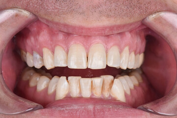 Close up front view teeth picture fixator gel braces before dental treatment