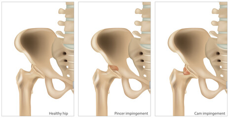 Medical illustration of the Femoroacetabular Impingement. Different of the Cam impingement and Pincer impingement. Healthy hip - obrazy, fototapety, plakaty