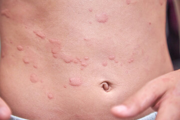 food allergy. a boy with red spots. The child has itching, with an allergic rash..