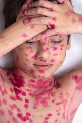 Obraz na płótnie Canvas Close-up of cute little children. Chickenpox virus or vesicular rash on a child's body