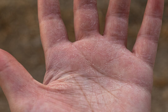 mano deshidratada con la piel seca y escamosa por el frio