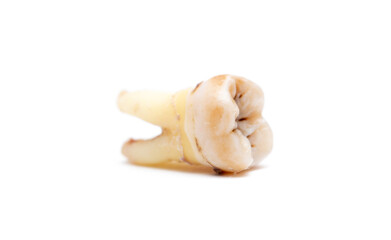 Close-up of a tooth with caries isolated on a white background. Removed wisdom teeth. Sick human teeth.