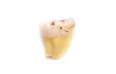 Close-up of a tooth with caries isolated on a white background. Removed wisdom teeth. Sick human teeth.