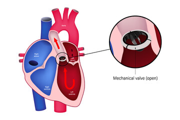 Aortic valve replacement with mechanical valve. Close up of closed mechanical valve. Heart anatomy vector.