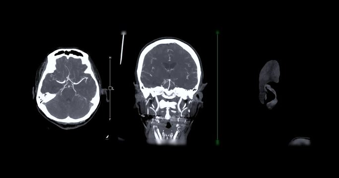 CTA  Brain or Computed tomographic angiography of cerebral artery 2D image for diagnosis cerebral artery aneurysm and stroke diseases