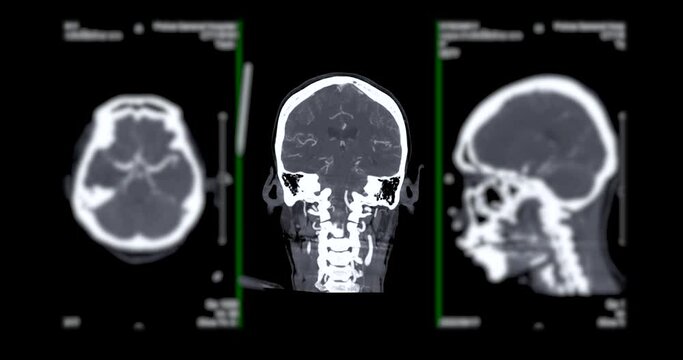 CTA  Brain or Computed tomographic angiography of cerebral artery 2D image for diagnosis cerebral artery aneurysm and stroke diseases