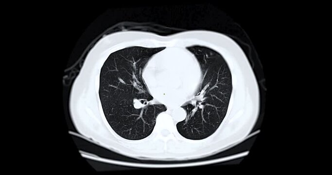 CT Chest or CT Scan of  Lung used filter lung window  for diagnosis TB,tuberculosis and coronavirus or covid-19 .
