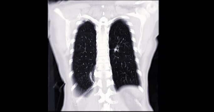 CT Chest or CT Scan of  Lung used filter lung window  for diagnosis TB,tuberculosis and coronavirus or covid-19 .
