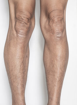 Leg And Knee Joints Of The Elderly With Muscle And Bone Degeneration Lesion, Dermatitis, Dark Spots Of The Skin On The Legs On A White Backdrop.