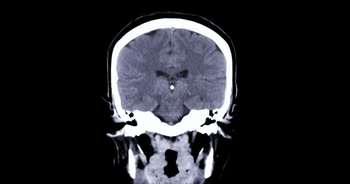 CT scan of the brain for diagnosis brain tumor,stroke diseases and vascular diseases.