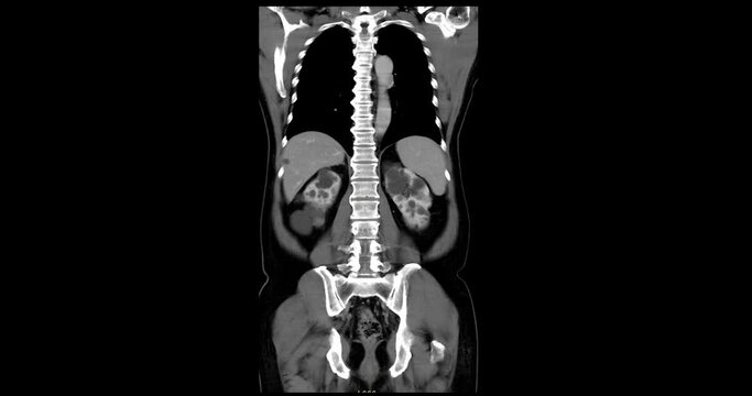 CTA abdominal aorta for Evaluation of the abdominal and thoracic aorta after stent replacment in case abdominal aortic aneurysm.