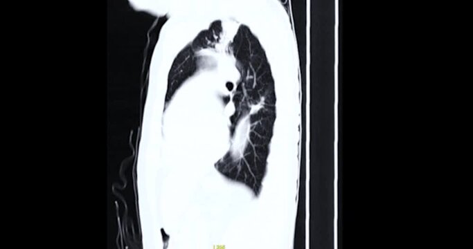 CT Chest or CT Scan of  Lung used filter lung window  for diagnosis TB,tuberculosis and coronavirus or covid-19 .

