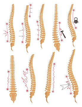 Spinal deformity types. Symbols of spine curvatures or unhealthy backbones. Human spine anatomy, curved spine. Diagram with marked sections. Body posture defects