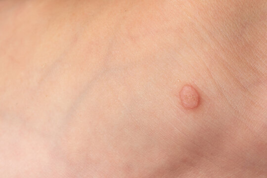 Common wart Verruca vulgaris on the skin of a child.