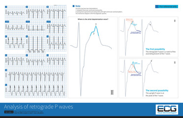 During an episode of tachycardia, retrograde P waves can overlap any part of the T wave, forming a T wave notch that is sometimes misdiagnosed as an upright P wave.