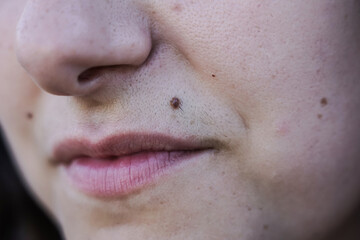 Facial hair of girl. Small mustache near the mouth of a woman with many moles. Aestheticism and...