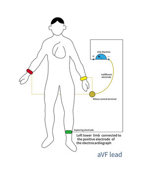 The positive pole of aVF lead is placed on the left lower limb, and the negative pole is an improved central terminal, which is actually a bipolar lead.